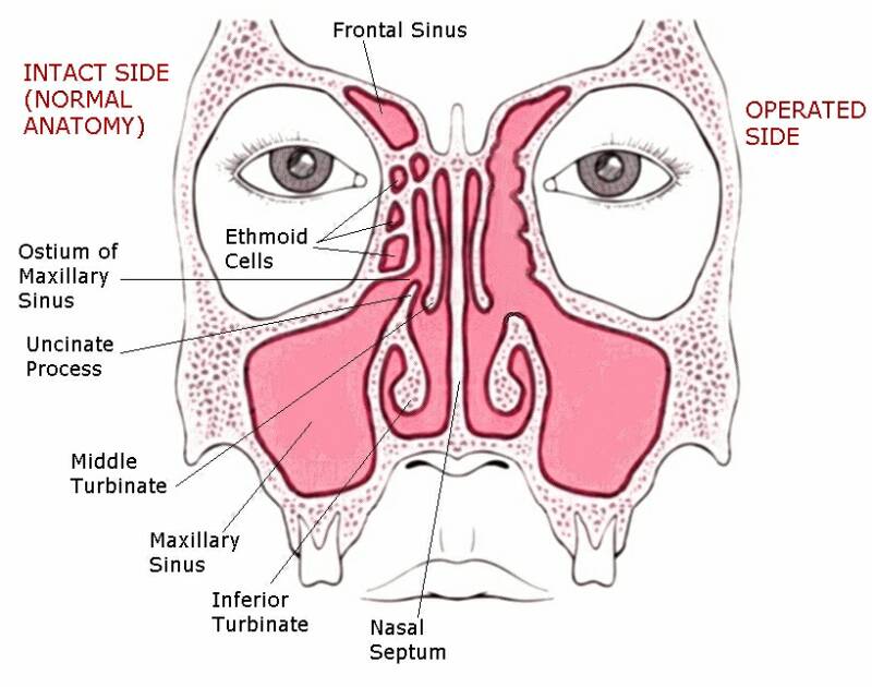 dr ananda functional endoscopic sinus surgery maxillary sinus